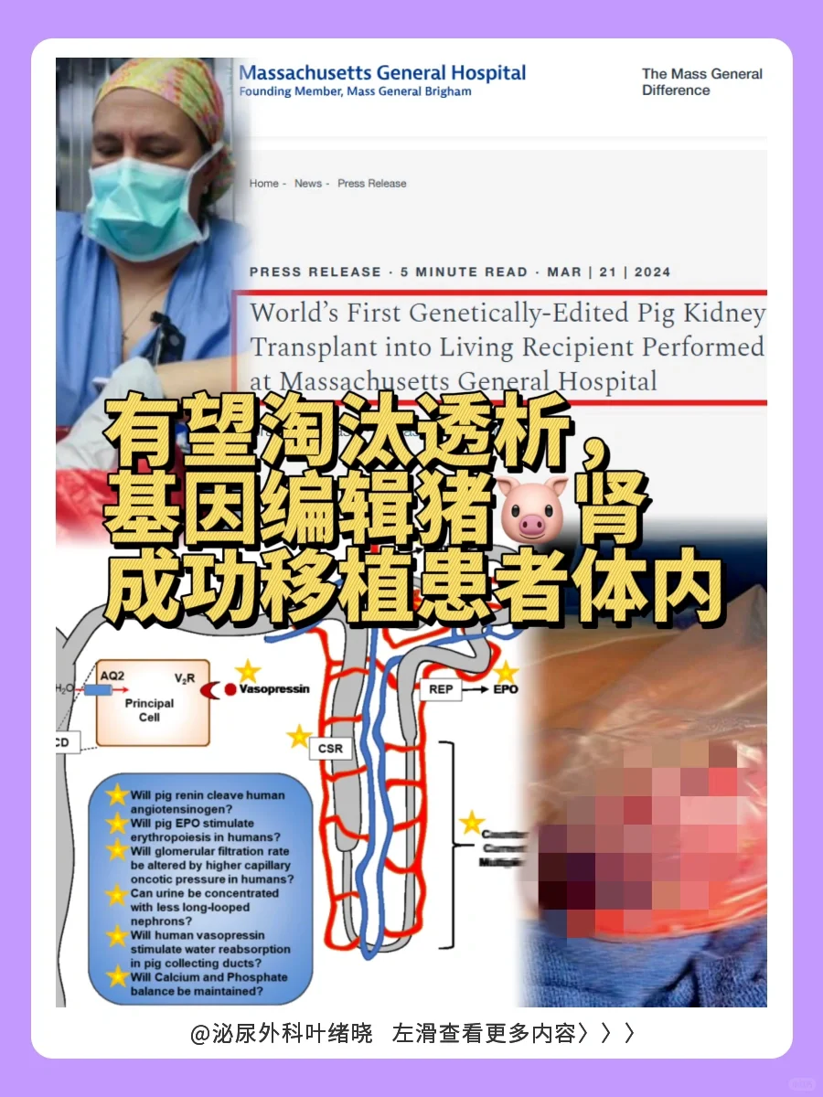 有望淘汰透析，基因编辑猪肾成功移植患者体,试管代孕做双胞胎